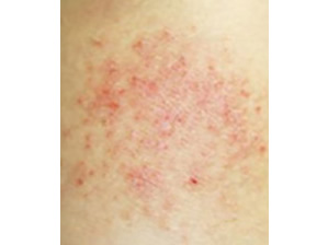 金属アレルギー例